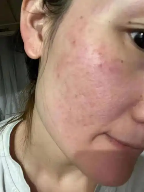 敏感肌皮肤用施洛贝缇珍珠膏的真实反馈