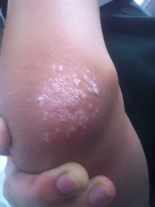 手肘处这是什么症状?