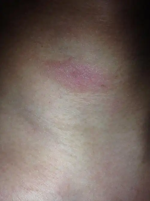 硬皮变成屑掉落泛红胸口的看样子像毛囊鼓起小疙瘩红色的聚集成的使劲