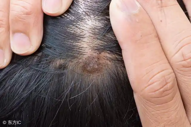 头上出现4个变化,是螨虫已爬入毛囊征兆,很多人不知晓_头皮