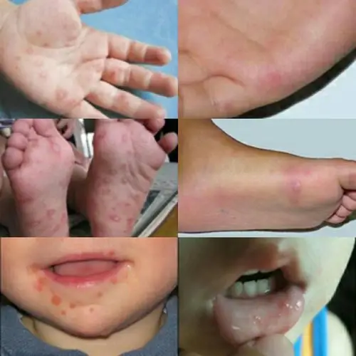 双城镇幸福社区幼儿园温馨提示——手足口病高发季,保护好我们的宝宝!