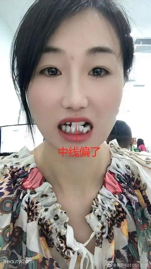 你有拔过虎牙吗?