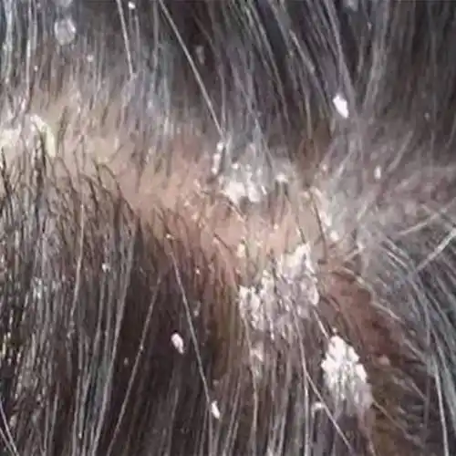 顽固头屑用什么洗发水?去屑蓬松洗发水推荐_头皮_问题