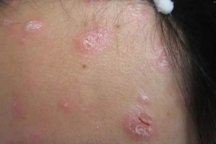 各种皮肤病对照图