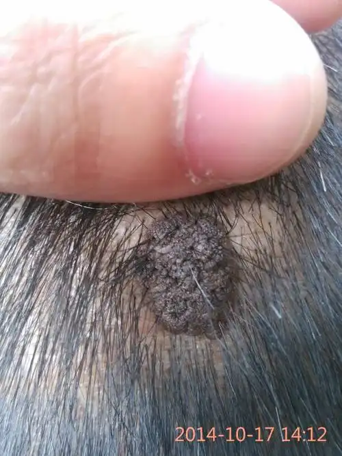 老爸头上长了个小疙瘩,黑黑的,有点像痣,但又有点不像.