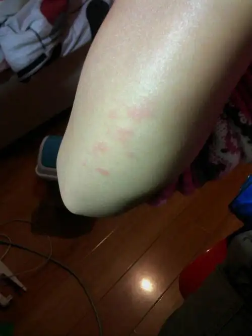 擦了红霉素软膏还好些了,这怎么回事?