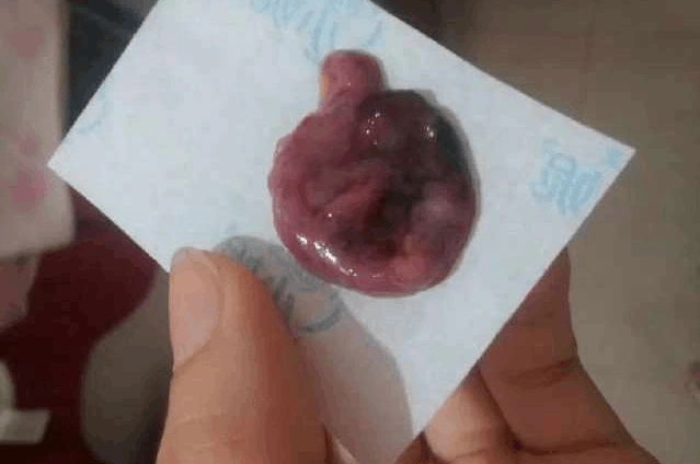 整个孕期它都会随时夺走胎儿!准妈妈却对它不太了解!