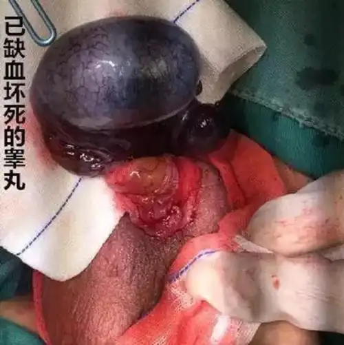 又一起悲剧(睾丸扭转导致的睾丸切除)!