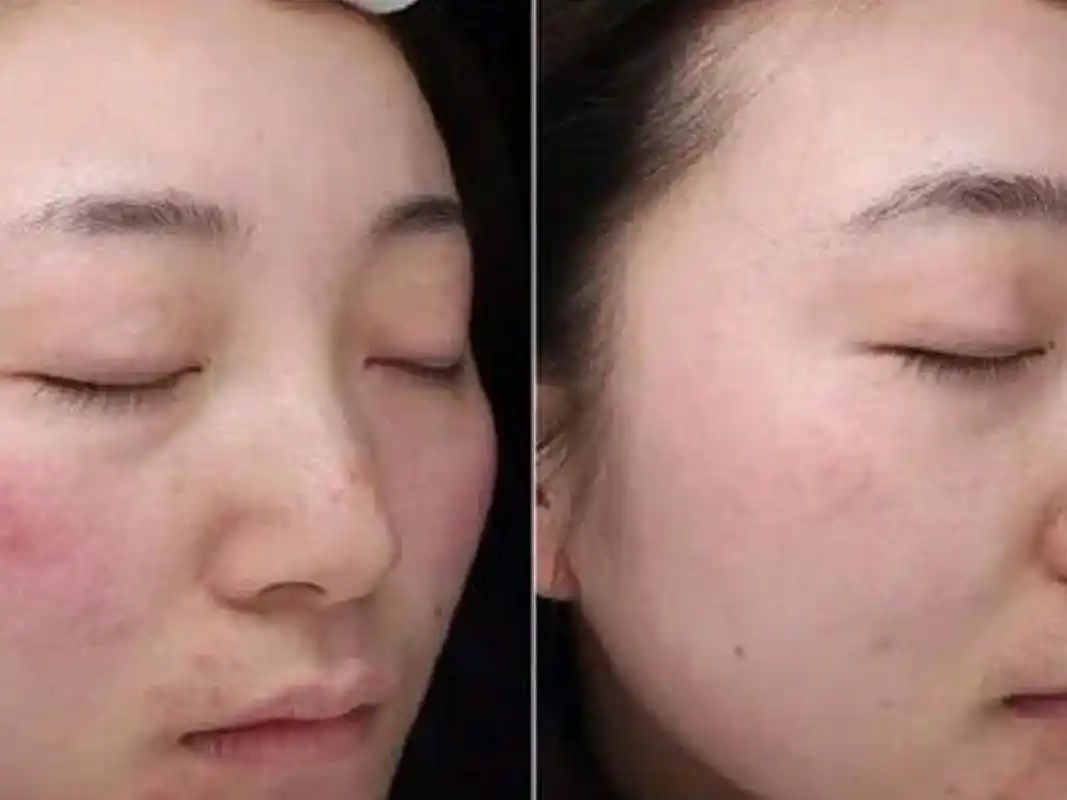 果酸换肤后注意事项 果酸换肤后应该注意的七点