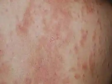 湿疹性皮炎的疾病定义