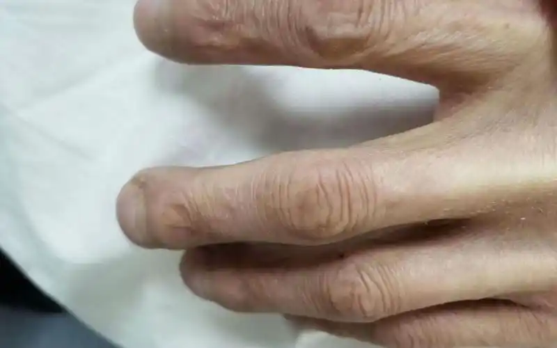 你注意过癌症患者的手吗?赶紧看看