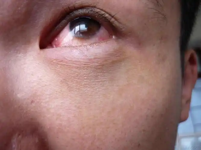 眼球与眼白交界处变色突起眼白有红血丝求助