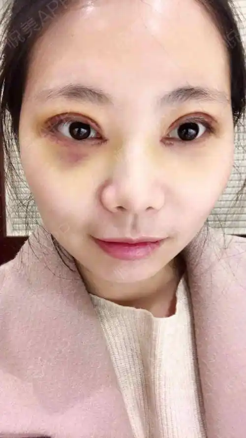 宝宝们好切开双眼皮已经第2天,才刚做完手术第二天的我依然在上班