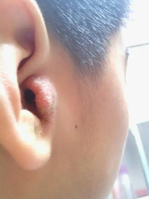 问:我的耳朵怎么了 怎么办 急急急