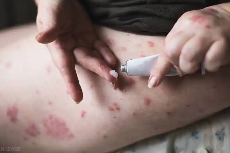 皮肤上突然出现了水疱,可能是什么病?应该怎么办呢?