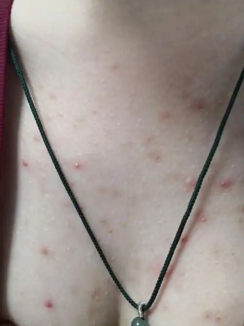 解决皮肤问题专注皮肤美容##马拉色菌毛囊炎