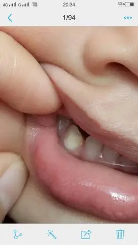 两岁孩子虎牙变黄了怎么回事?有医生吗,给看下!