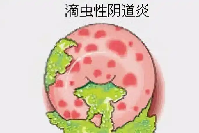 如何杜绝滴虫性阴道炎_女性_症状_生殖器