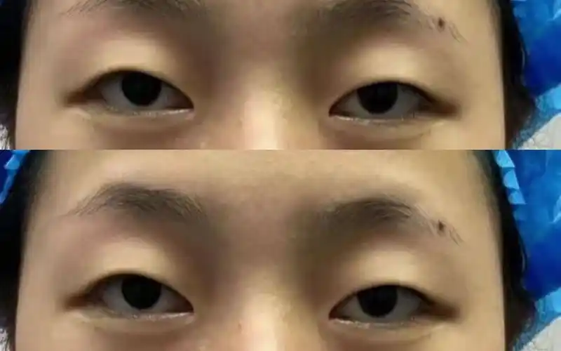 小姐姐是天生的大小眼 上睑提肌无力,一起来看看她的双眼皮效果怎么样