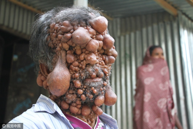 高能慎入!孟加拉男子得怪病全身长满神经纤维瘤