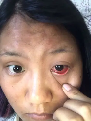 时不时的感觉眼角哪里像是东西遮住的感觉,是什眼睛疼红肿,.