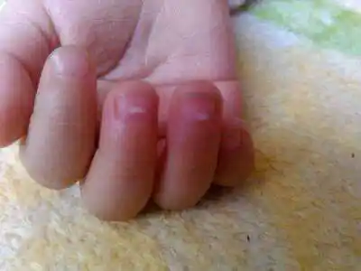 宝宝指甲上的小白点,是肚子里有虫子还是缺微量元素? .