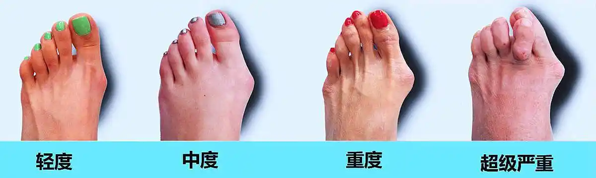 拇外翻是指拇趾在第一跖趾关节处向外偏斜超过正常生理范围的一种前足
