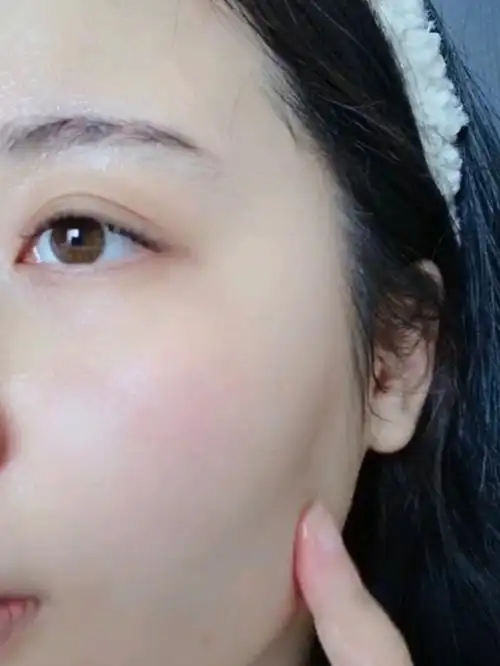 洗完脸后皮肤紧绷会更容易长痘吗