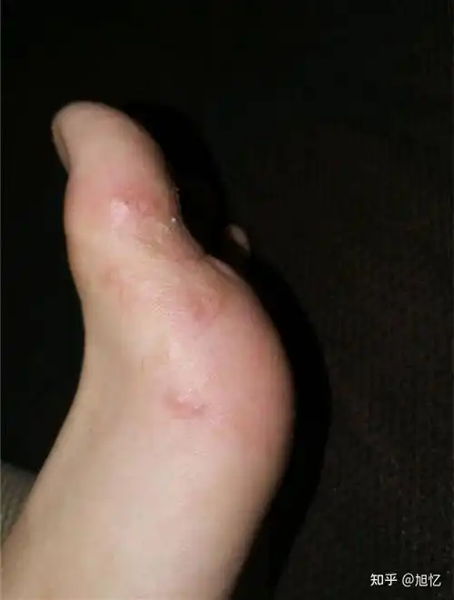 花季少女得脚气了怎么办脚气真实经历分享