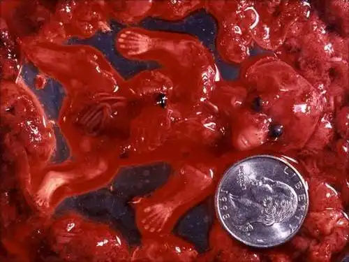 如果你妈妈爸爸当初也因为种种原因把你打掉了,你怎么想?