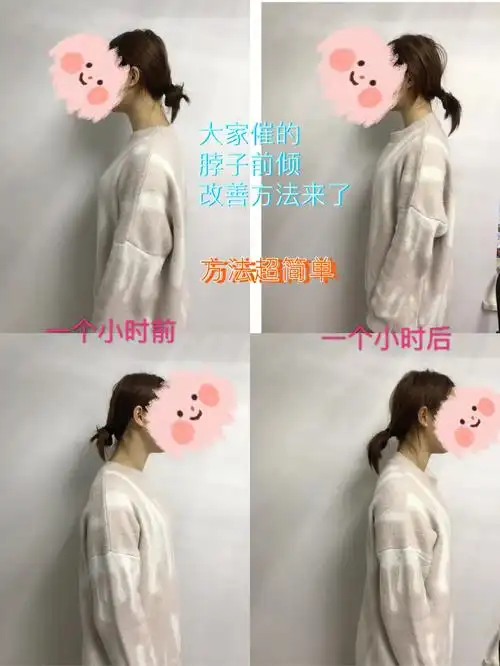 姐妹们催更的改善脖子前倾的方法