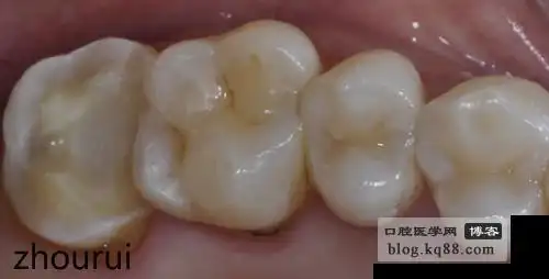 牙体制备之第二磨牙周锐医生