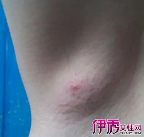 【图】妇检淋巴结严重吗 腋下淋巴结肿大症状有哪些