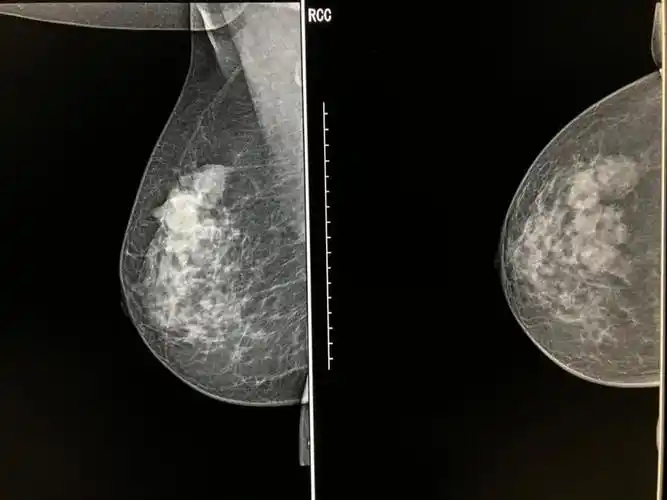 "钼"光汇聚,"靶"握健康,从乳腺做起!_乳房