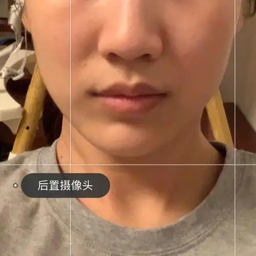 们说拔了法令纹变深,我倒是没注意过这个问题,然后现在我就整天看我脸