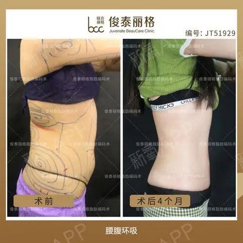 俊泰丽格腰腹环吸