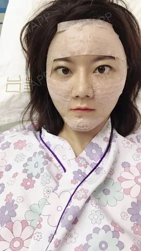 成都自体脂肪全脸填充好不好_效果图_有马自体脂肪全脸填充术后第3天