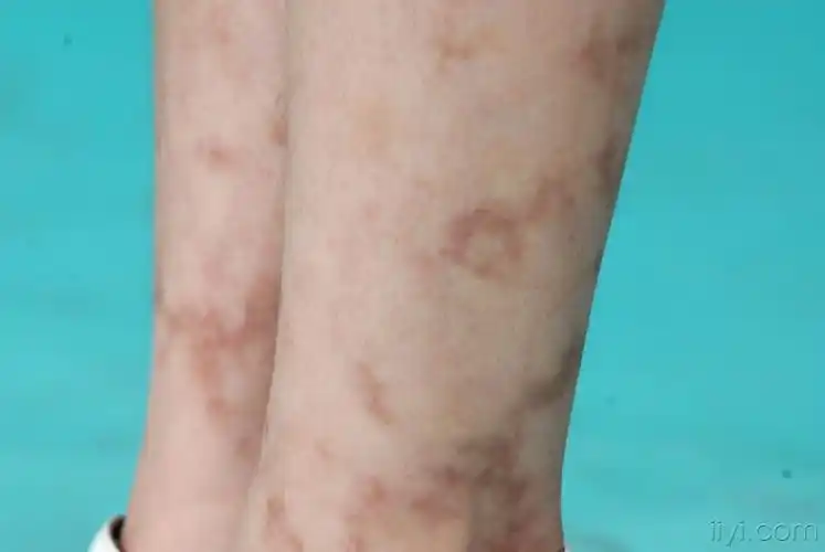 双下肢不规则形状色素斑18个月 - 皮肤及性传播疾病讨论版 - 爱爱医