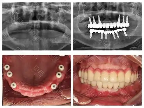 全口种植牙前后对比效果图
