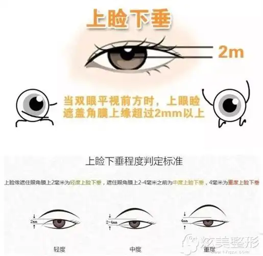 眼睑下垂矫正对比图来了先天老化or手术失败都可修复