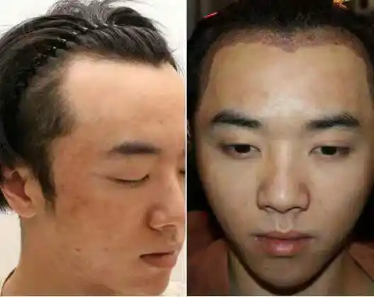 16日,有媒体发布一条华晨宇植发照片,确认无疑,紧接着又发出各整容