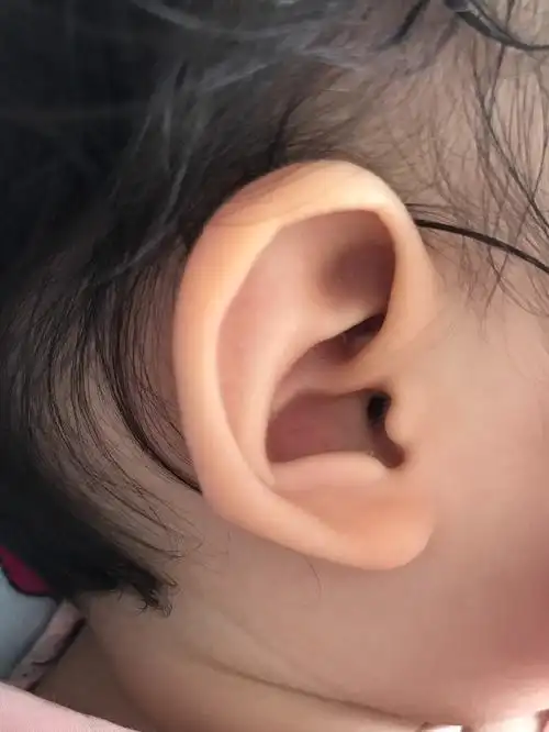 一岁宝宝耳廓的白色疙瘩是什么