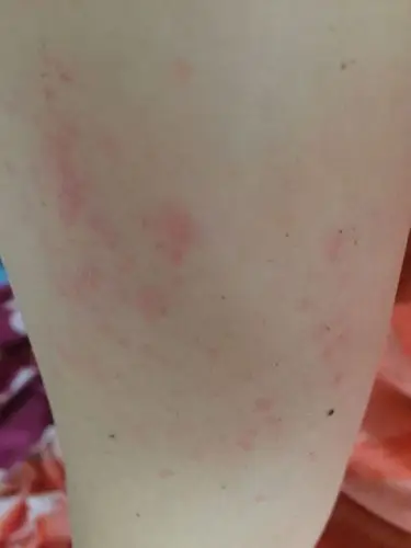 这个到底是热毒还是过敏啊.好痒.而且抓哪里哪里就会冒出来.越抓越多.