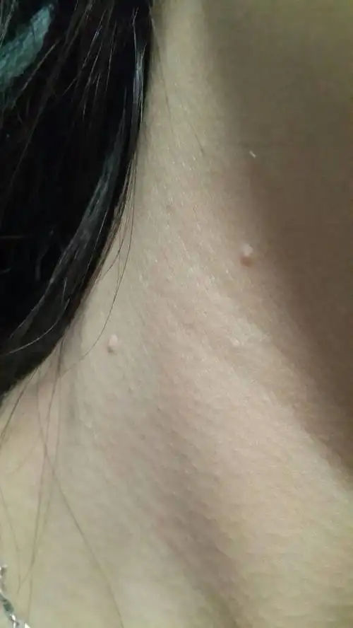 脖子上长了好多小肉疙瘩