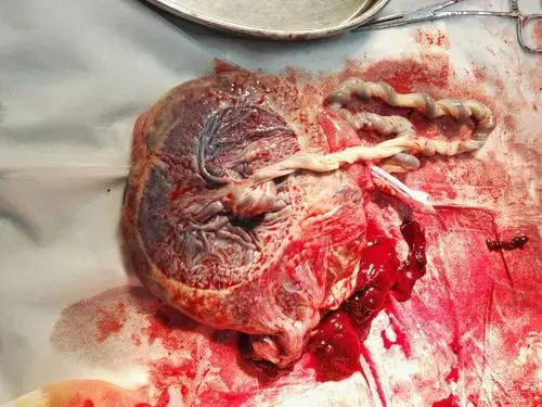 素引产,分娩时见血性羊水,宝宝出来1分钟评分10分,检查胎盘为轮状胎盘