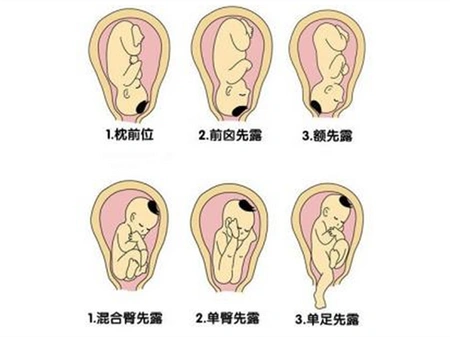 胎位loa是什么意思