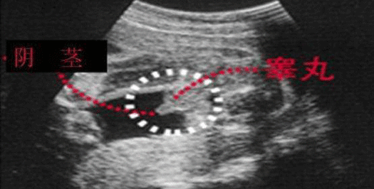 四维彩超怎么看男女 教你另辟蹊径看胎儿性别