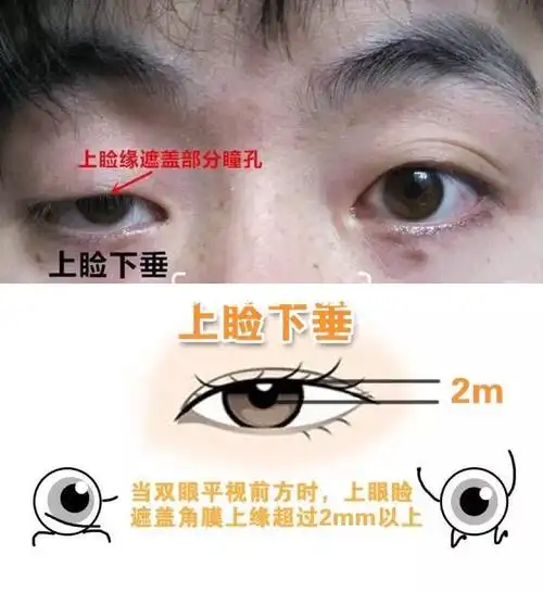 上睑肌无力是什么表现