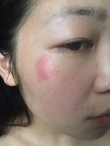 我脸上眼睛旁边瘙痒并出现一片红肿怎么回事,反反复复好了又出现,好的