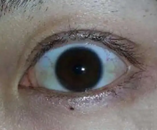 贫血的人有五大典型症状,转发让更多的人知道